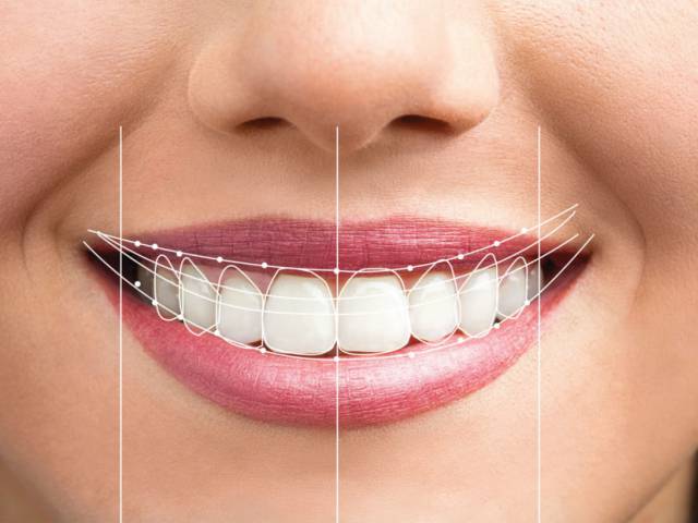 Коронки и преображение улыбки (smile design) - Сиде, Анталья